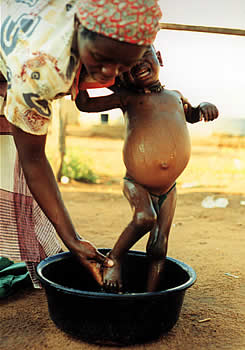 little boy suffers from malnutrition